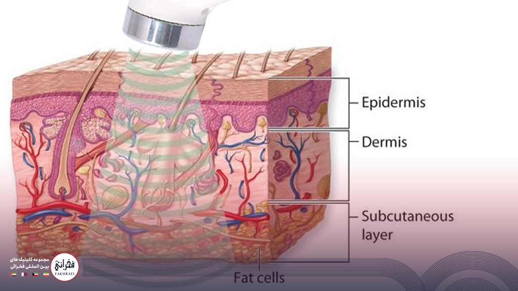هایفوتراپی پلک-تصویر بافت پوست