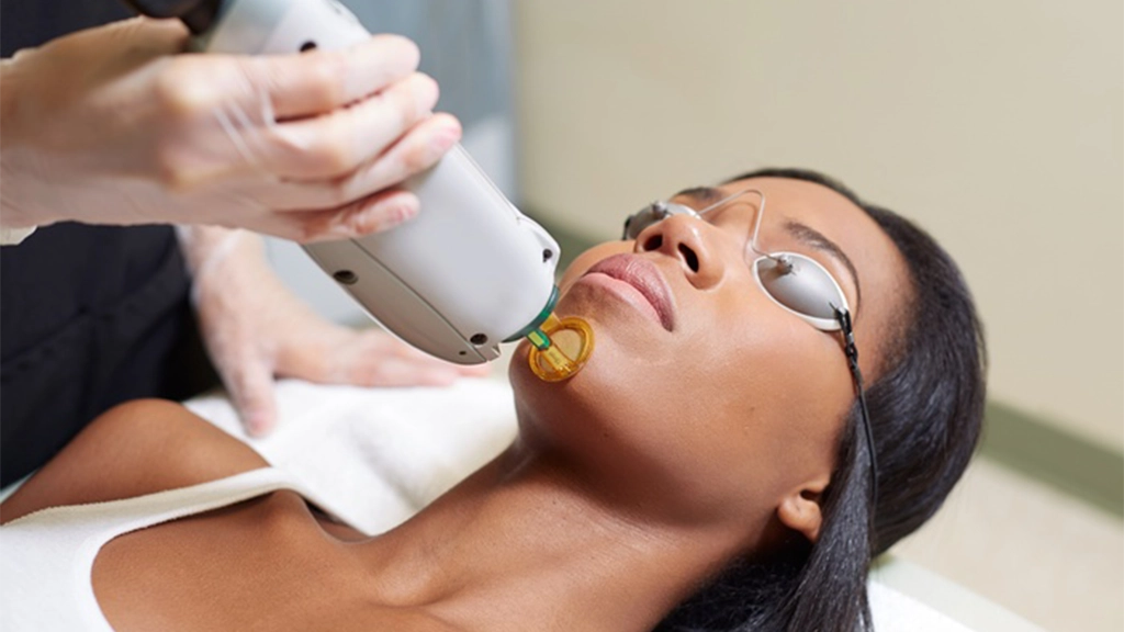 مزایای لیزر موهای زائد صورت