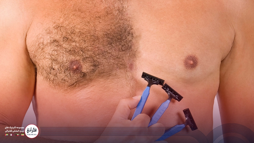 هزینه لیزر موهای زائد مردان