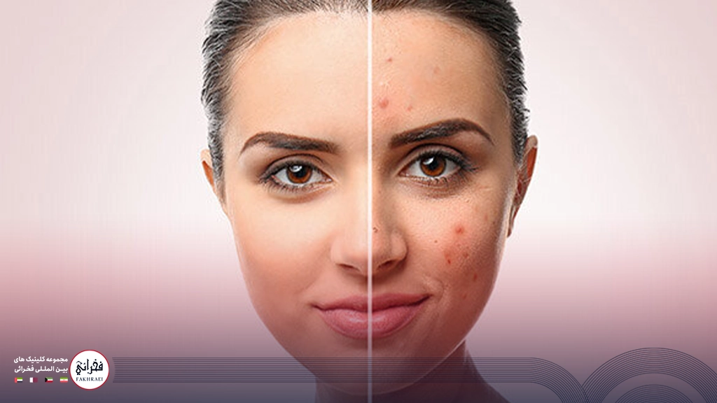 میکرونیدلینگ بهتر است یا لیزر co2-زنی با دو نیمه صورت بدون جوش و جوش دار