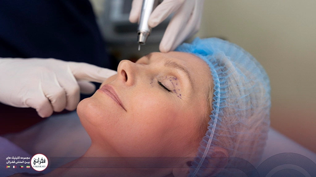 بلفاروپلاستی زنی در حال انجام عمل پلک