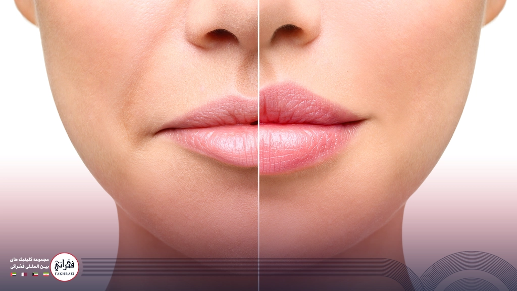 تصویر قبل و بعد از تزریق ژل