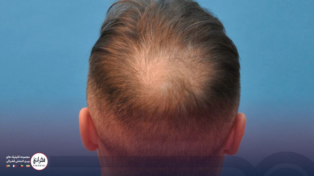 کاشت مو در ناحیه ورتکس-مرد با پشت سر خالی