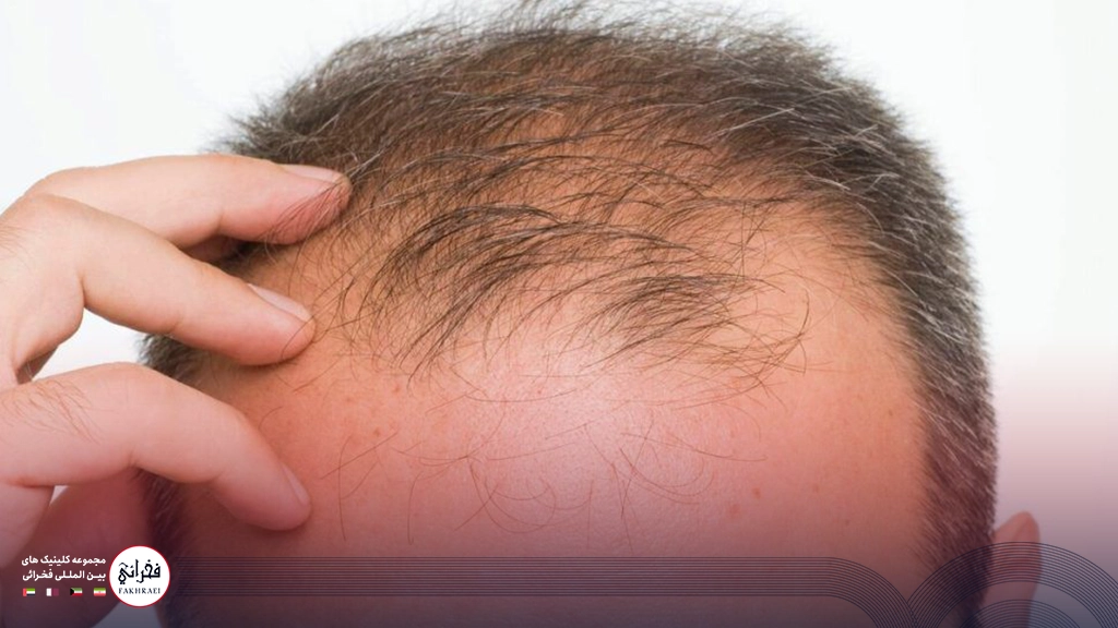 کاشت مو در ناحیه ورتکس-مردی با جلوی سر خالی