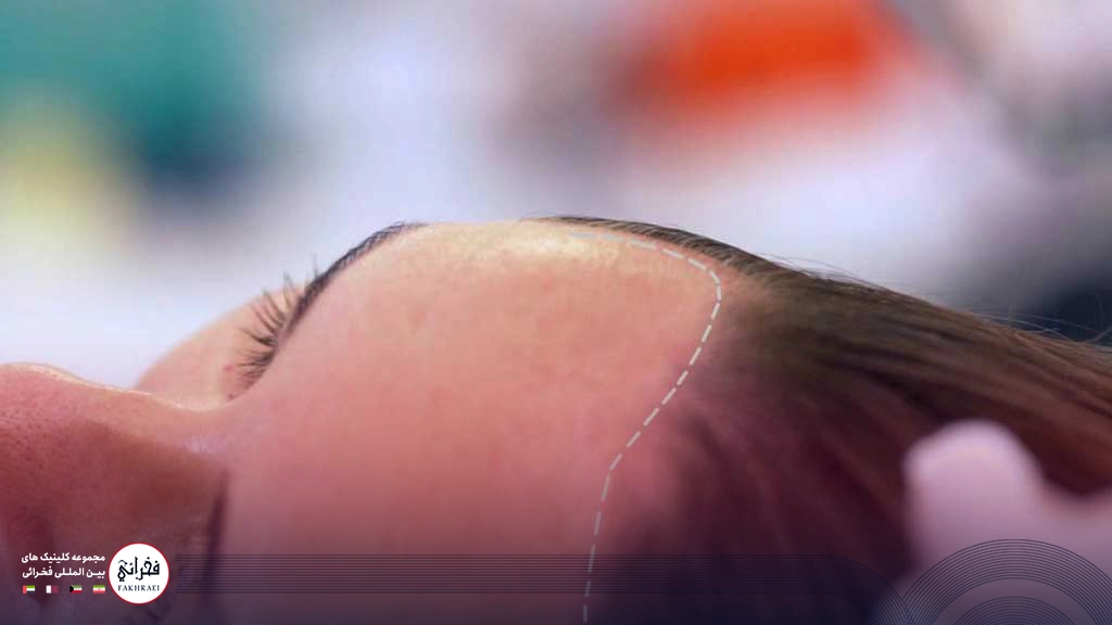 خط رویش مو در زنان