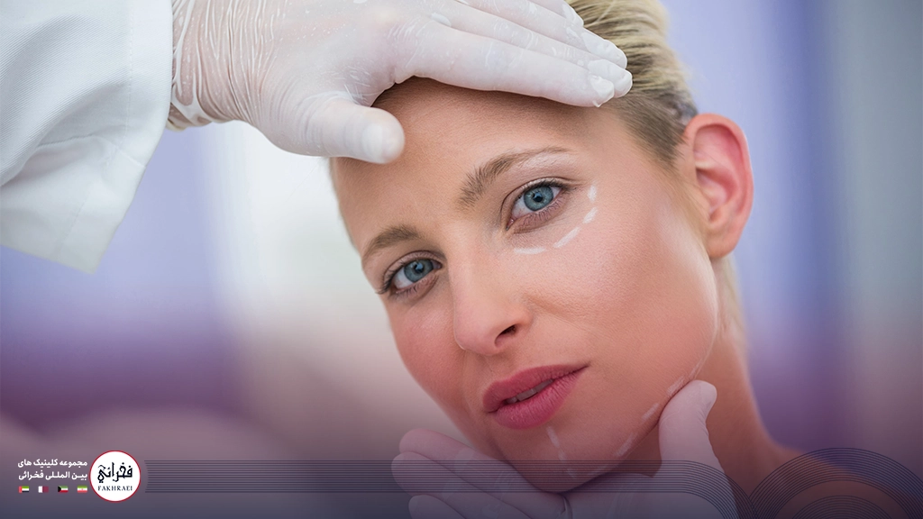 لیفت شقیقه با نخ-خانومی با پوست روشن و زیر چشم خط کشی شده