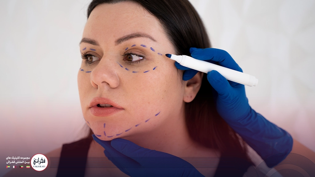 لیفت شقیقه با نخ-خانومی با صورت چاق و خط کشی روی پوستش