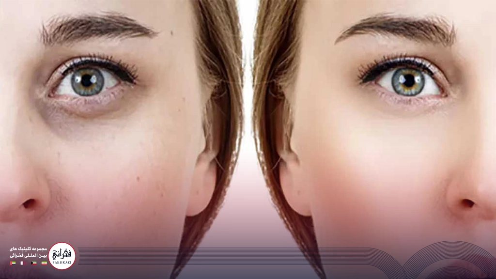 نتیجه استفاده از مزوژل و فیلر زیر چشم
