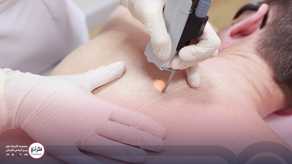 لیزر سایناشور بهتر است یا کندلا؟-در حال انجام لیزر کمر آقایی