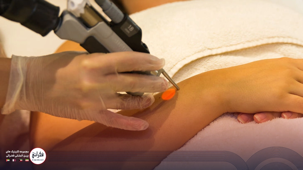 لیزر سایناشور بهتر است یا کندلا؟-در حال انجام لیزر دست