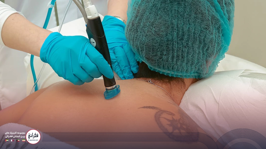 لیزر سایناشور بهتر است یا کندلا؟-در حال انجام لیزر پشت بدن