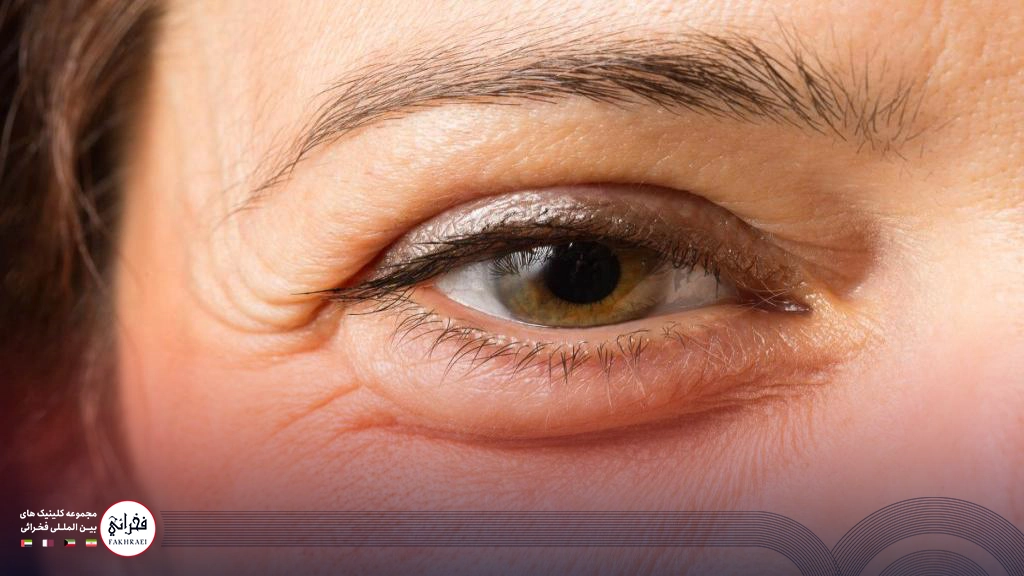 مزوتراپی زیر چشم-زیر چشم چروک خانومی