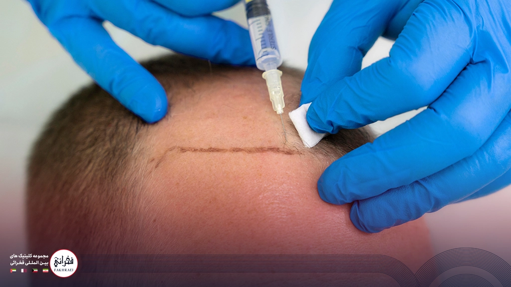 پی آر پی مو-تزریق به جلوی سر آقایی