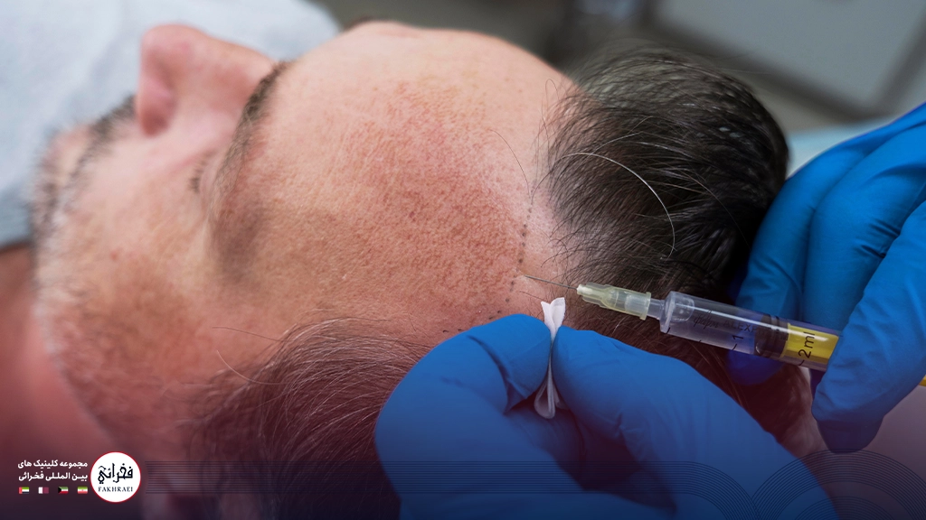 پی آر پی مو-تزریق به کف سر مردی