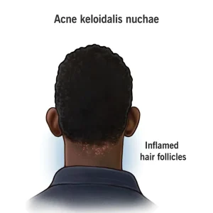 آکنه کلوئید نوچا