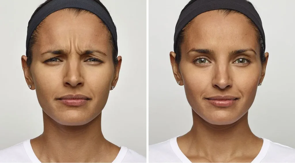 تصویر قبل و بعد یک زن بعد از تزریق بوتاکس پیشانی