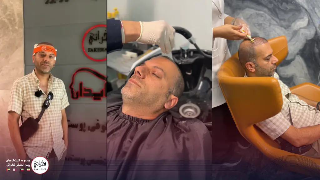 مراقبت های بعد از کاشت مو