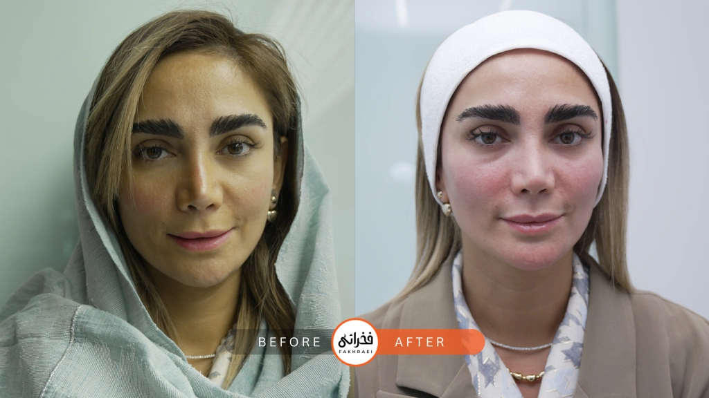 عکس قبل و بعد از فیلر گونه