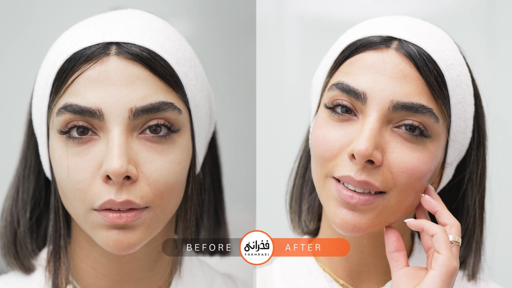 عکس قبل و بعد از فیلر گونه