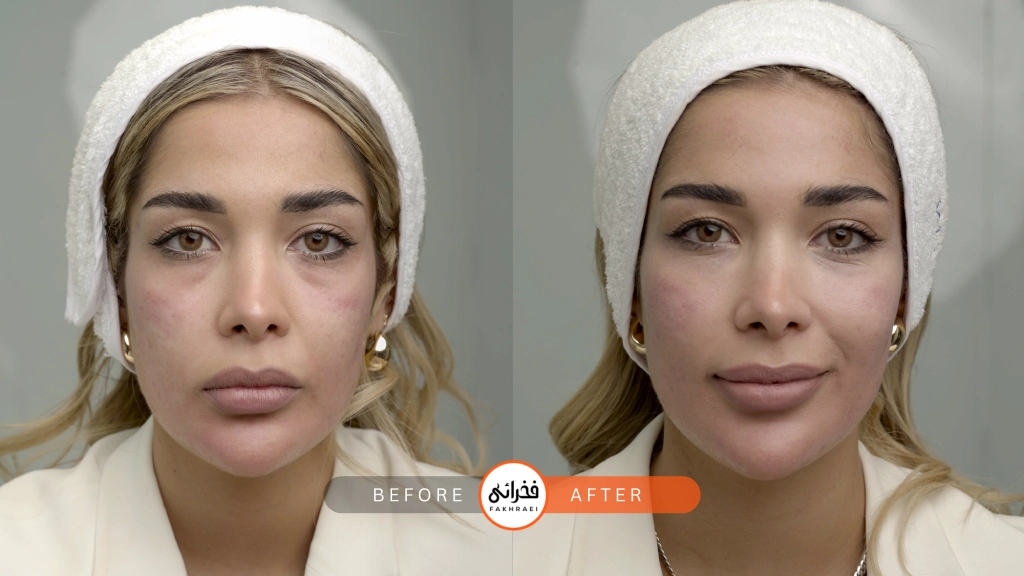 عکس قبل و بعد از فیلر گونه