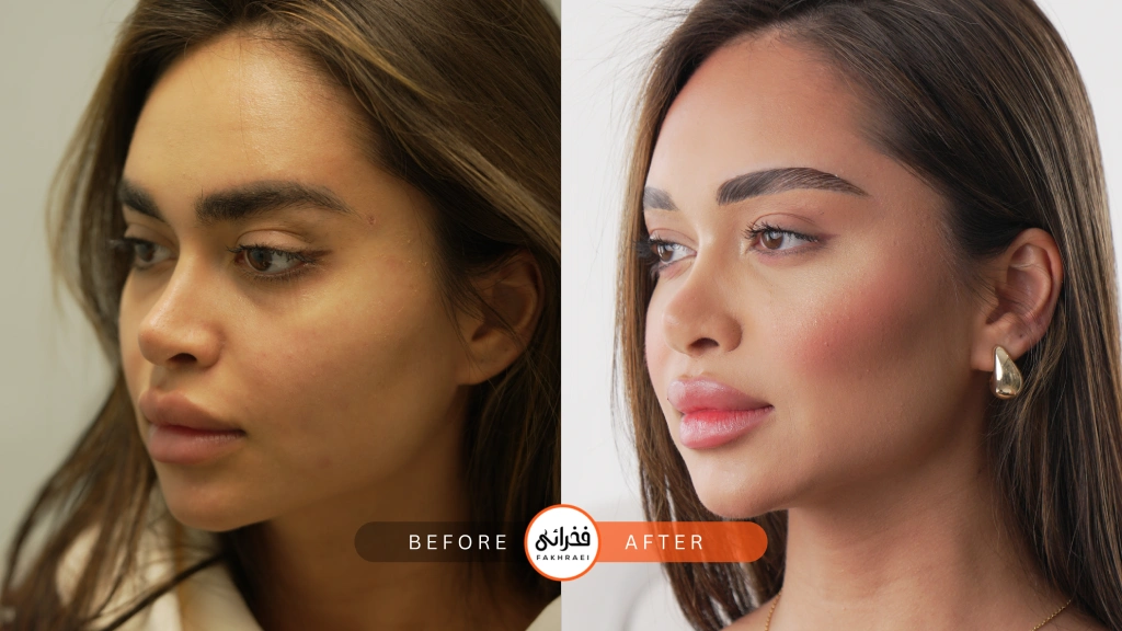 عکس قبل و بعد از فیلر گونه