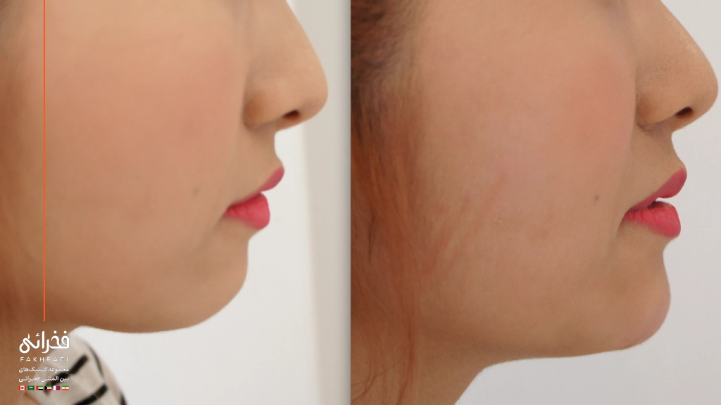 قیمت فیلر چانه