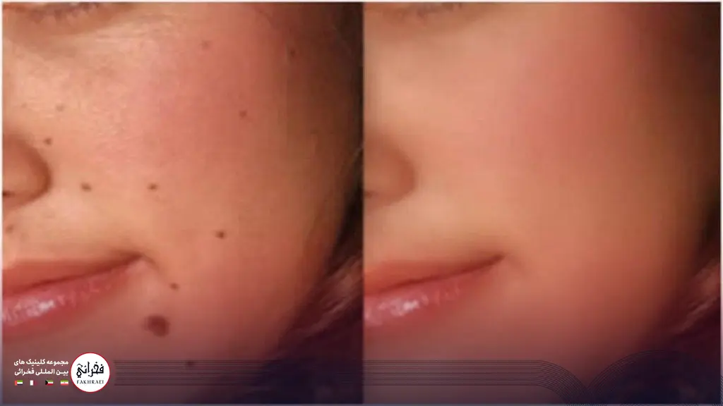 تصویر یک صورت قبل و بعد از لیزر فوتونا