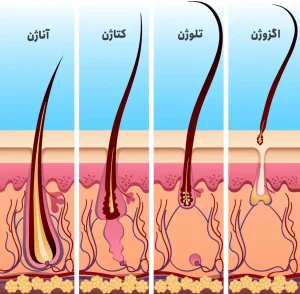چرخه رشد مو (اگزوژن)