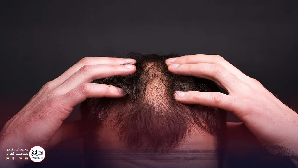 ریزش مو در اثر عفونت بعد از کاشت مو