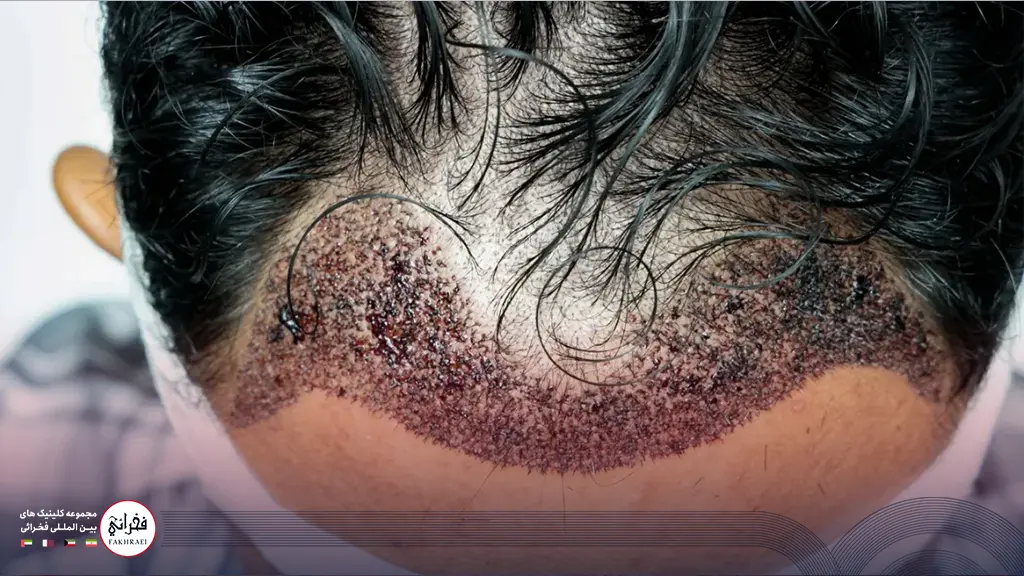 ایجاد عفونت پس از کاشت مو در جلوی سر یک مرد