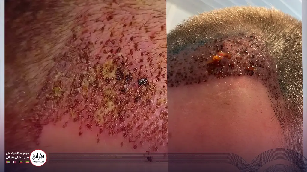 نشانههای عفونت کاشت مو