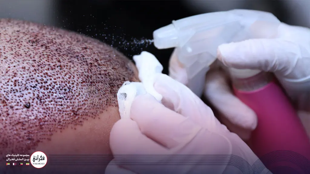 شستشوی سر برای جلوگیری از عفونت کاشت مو