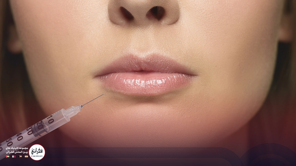 تزریق ژل لب نچرال-در حال تزریق ژل لب