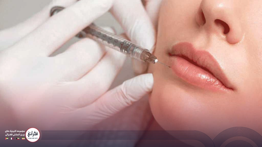 تزریق ژل لب مدل چاک دار -در حال تزریق ژل لب