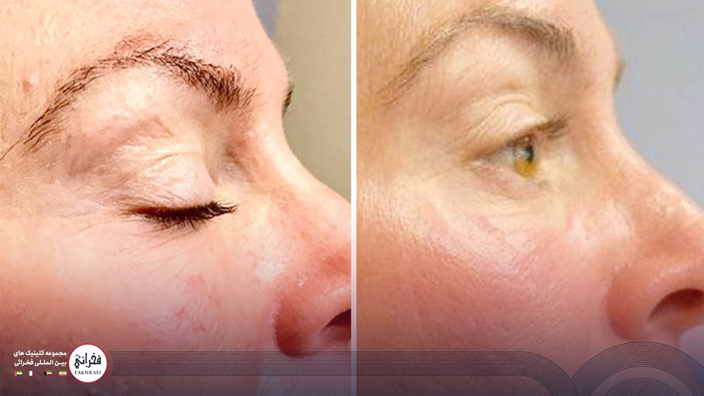 پی آر پی صورت-قبل و بعد پشت چشم خانمی بعد از تزریق