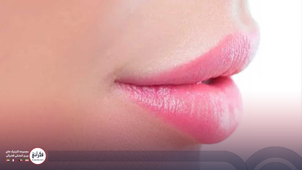 تزریق ژل لب قلبی -نیمرخ لب خانمی