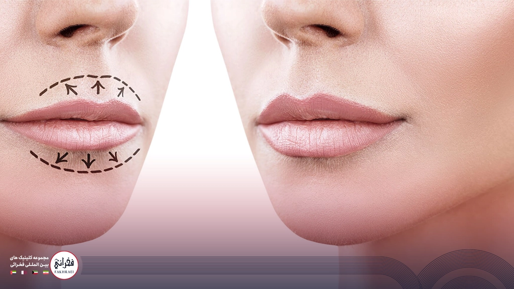 تزریق ژل لب مدل فانتزی -قبل و بعد خانمی بعد از ژل لب