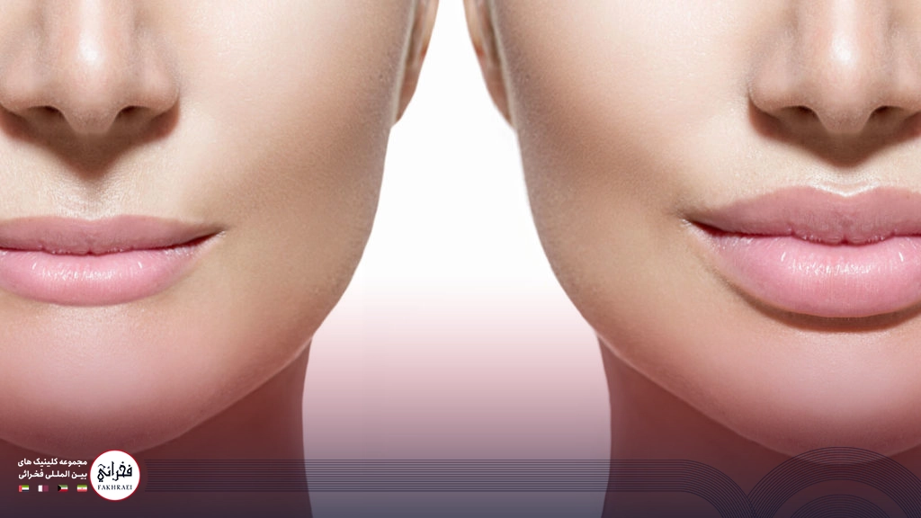 تزریق ژل لب مدل فانتزی -قبل و بعد تزریق ژل لب