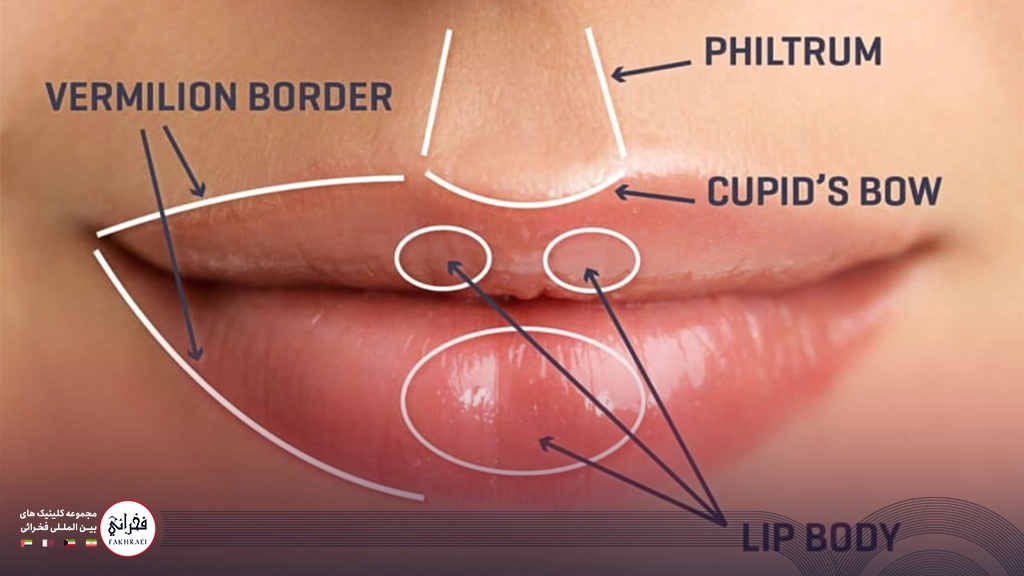 تزریق ژل لب مدل سه دکمه ای-مناطق مختلف لب برای تزریق ژل