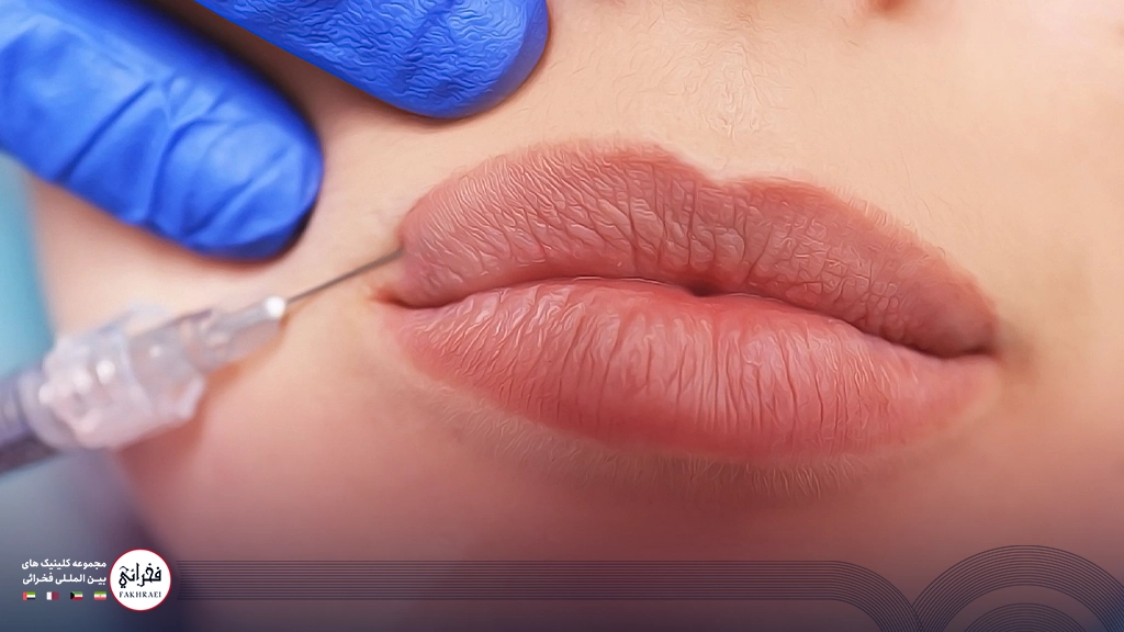 تزریق ژل لب مدل سه دکمه ای-تزریق ژل لب