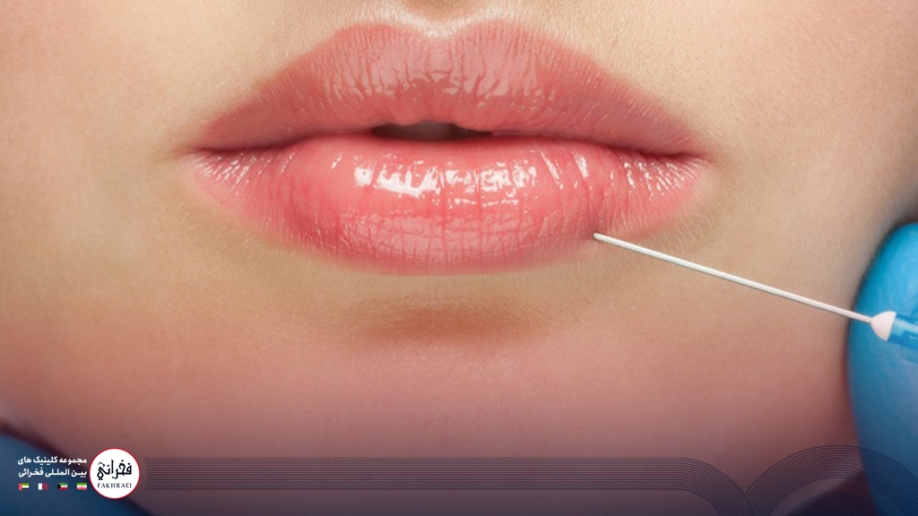 تزریق ژل لب مدل سه دکمه ای-تزریق ژل لب