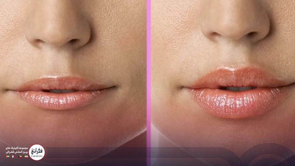 تزریق ژل لب مدل سه دکمه ای-قبل و بعد تزریق ژل