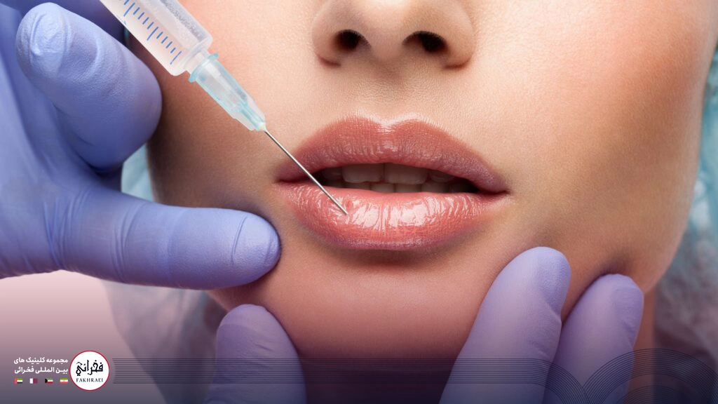 تزریق ژل لب مدل گرد-تزریق ژل لب