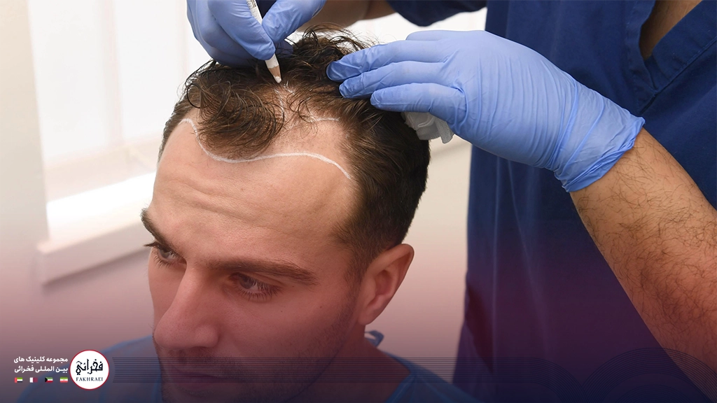 بهترین روش کاشت مو-در حال کاشت مو مردی