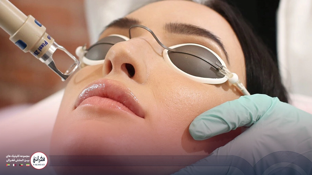 لیزر اربیوم یا CO2-در حال انجام لیزر صورت خانمی