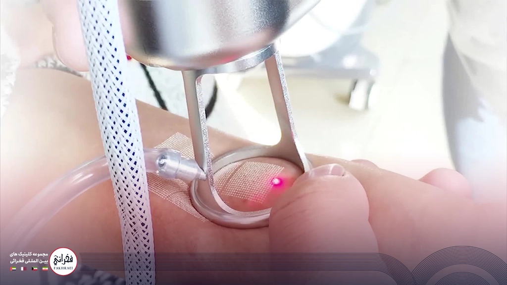لیزر اربیوم یا CO2-در حال انجام لیزر