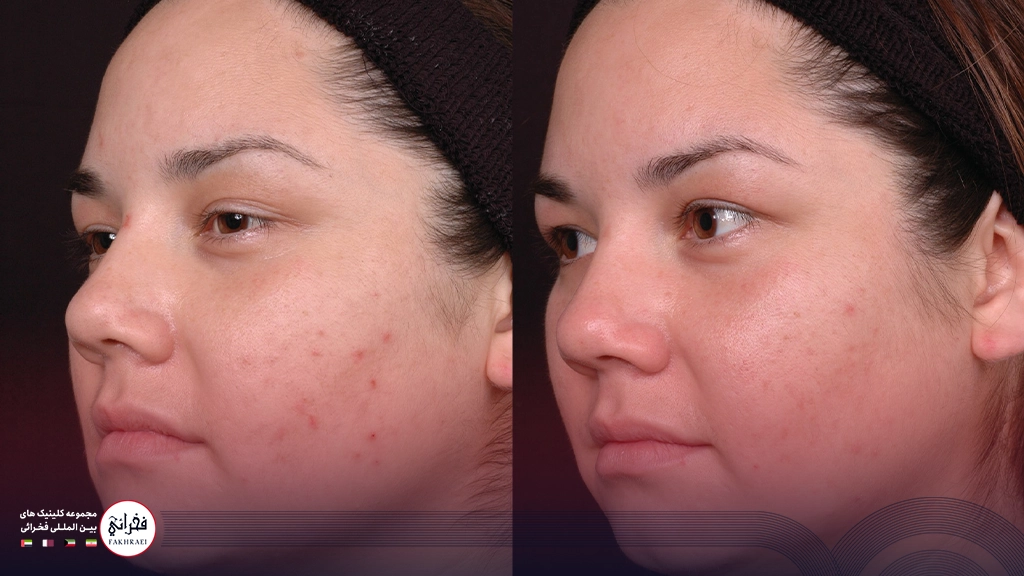 مزوژل برای جای جوش و زخم-قبل و بعد خانمی بدون جوش و همراه با جوش