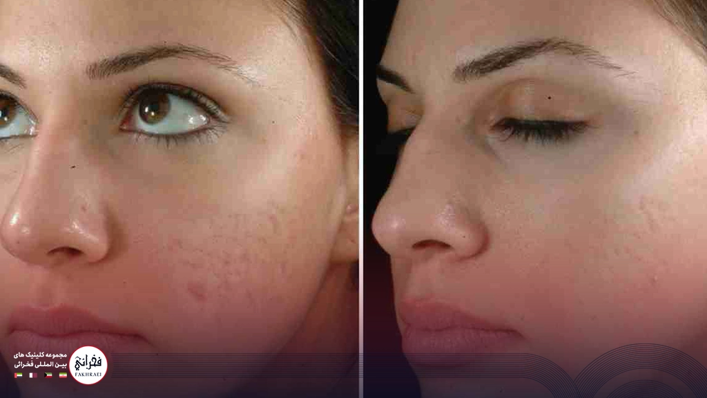مزوژل برای جای جوش و زخم-قبل و بعد خانمی با جوش و بدون جوش