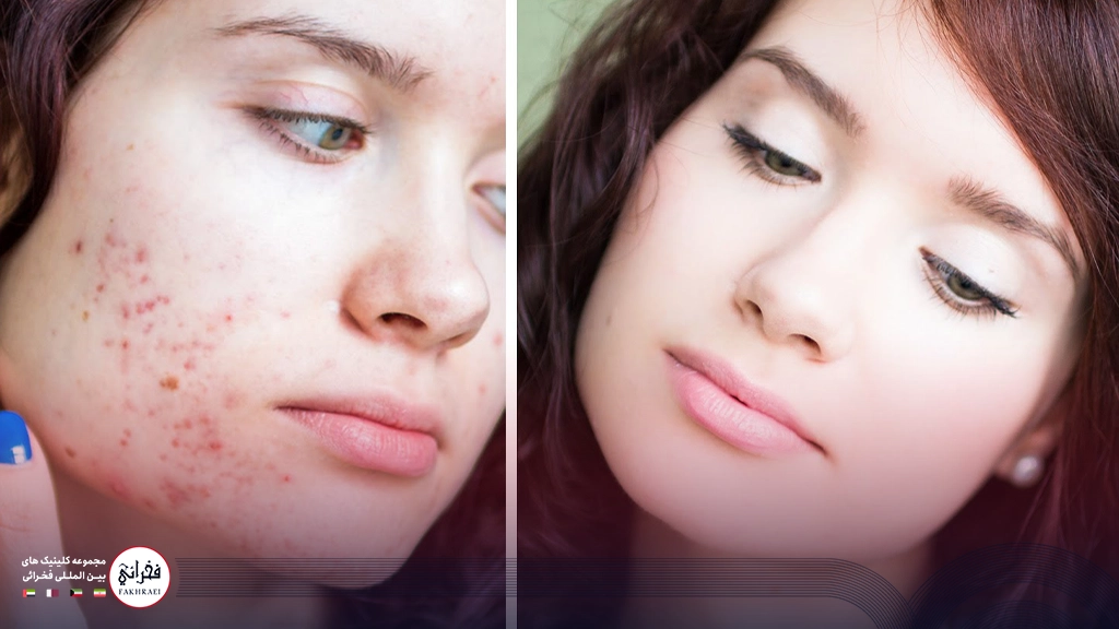 مزوژل برای جای جوش و زخم-قبل و بعد صورت خانمی بدون جوش و جوش دار