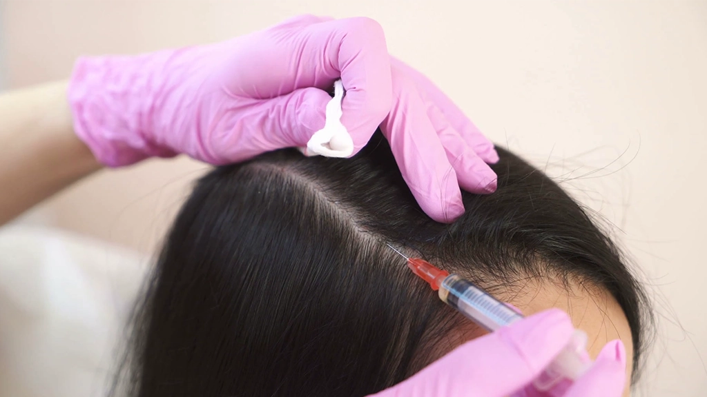 هیر فیلر-تزریق فیلر به موی خانمی
